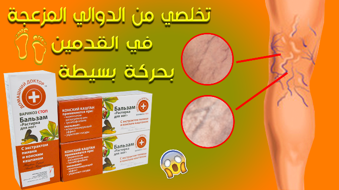 أفضل كريم للقضاء على الدوالي